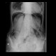 Pneumoperitoneum, pneumoretroperitoneum, massive, air in peritoneal cavity and retroperitoneum: X-ray - Plain radiograph